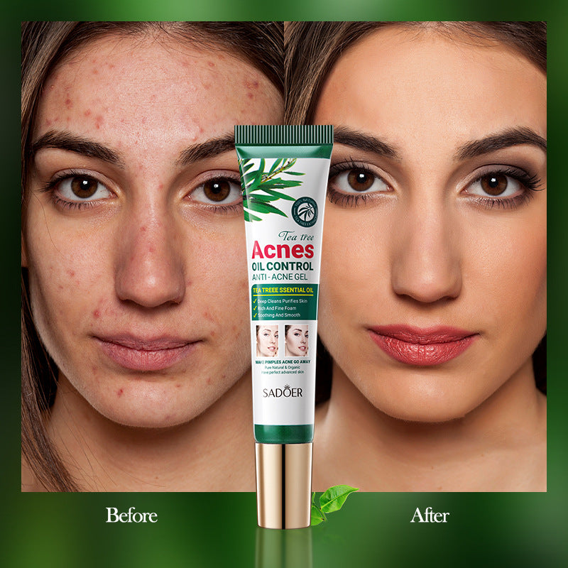 Tea Tree Medicated Gel for Acne Acne Removal Cream